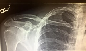 Collarbone-XRay